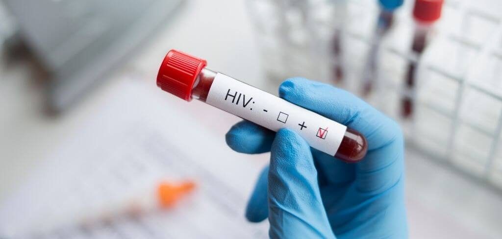Tubo de ensayo con etiqueta HIV positivo en laboratorio